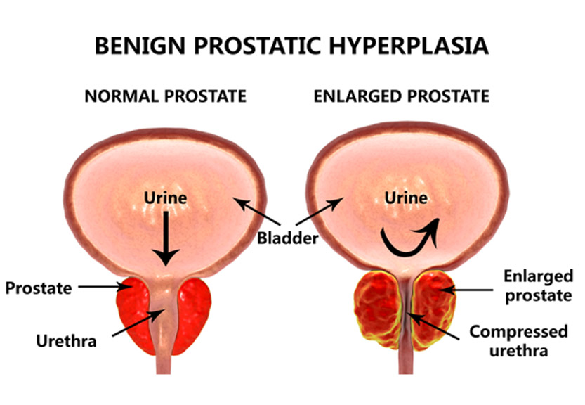 Medical-illustration-of-enlarged-prostate-(BPH)